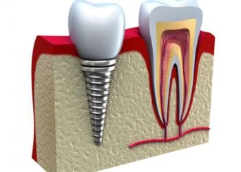 Dėl prastos dantų būklės vis daugiau Lietuvos jaunimo netenka dantų
