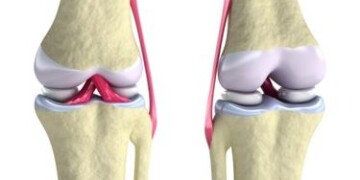 Sąnarių skausmas signalizuoja apie ligą, kurią gydyti privalu