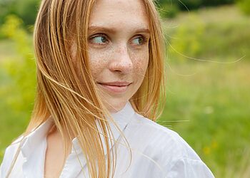 Strazdanos vasarą: kodėl jų padaugėja ir kaip prižiūrėti savo odą?